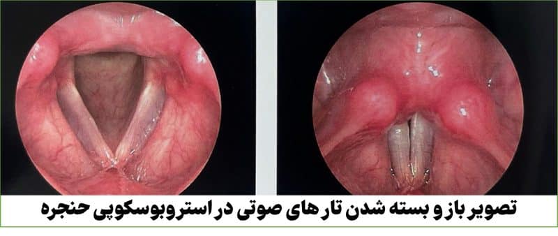 استروبوسکوپی یا تصویر برداری از حنجره