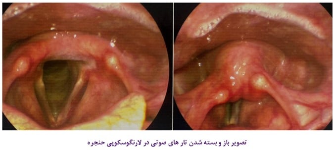 لارنگوسکوپی حنجره
