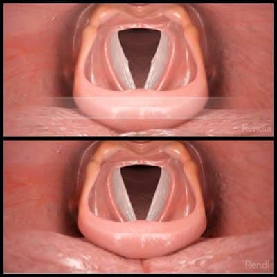 ندول تارهای صوتی علت، علائم و درمان 7 ندول تارهای صوتی تارهای صوتی حنجره